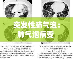 突发性肺气泡：肺气泡病变 