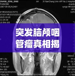 突发脑颅咽管瘤真相揭秘，探究疾病背后的秘密